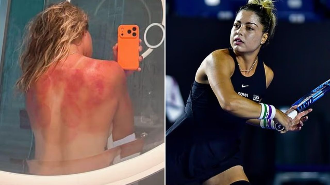 Renata Zarazúa Australia sunburn
